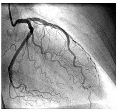X-ray image of coronary arteries