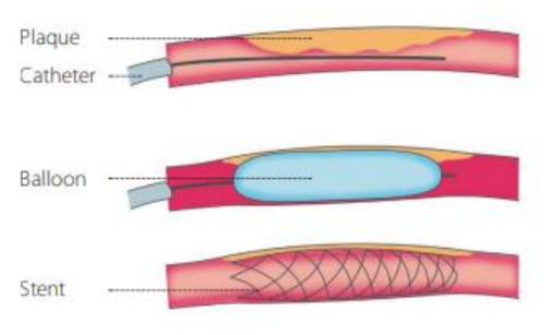 Three graphics of the process of a stent. A catheter, a balloon, and then the stent. 