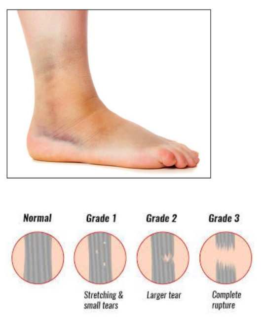 Image of ankle sprain.
Four images in circle showing grading of ankle sprain. 
Normal, Grade 1: Stretching and small tears, Grade 2: Large tear, and Grade 3: Complete rupture.