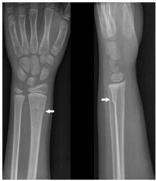 X-Ray scan of a buckle fracture
