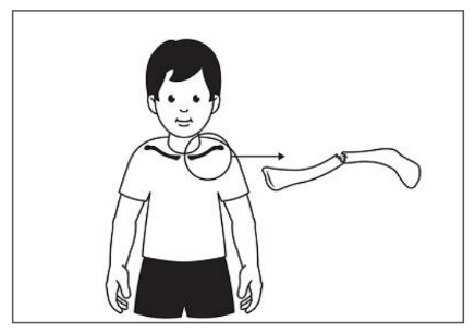 Drawing of child with a clavicle fracture (showing which bone).