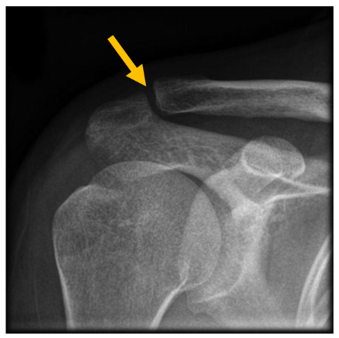 x-ray of collar bone spray