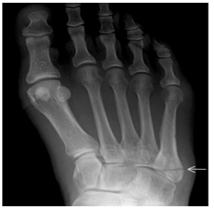 X-ray of Foot (5th Metatarsalbase) Fracture