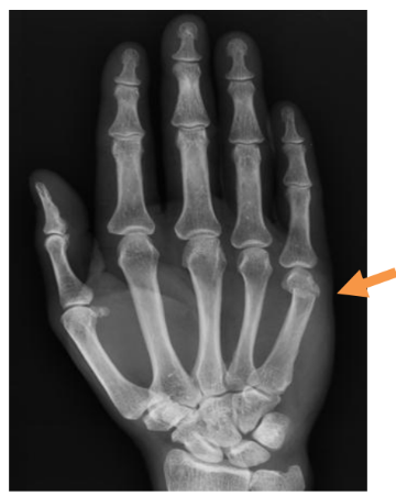 X-ray showing the Hand (5th Metacarpalneck fracture) 