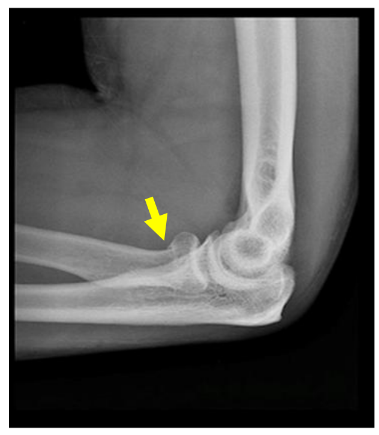 X-ray of a radial head/neck fracture