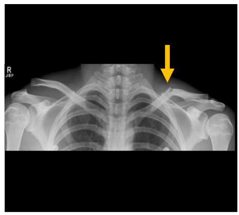X-ray of a clavicle fracture