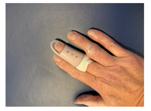 Photograph of hand with mallet finger injury with a splint.