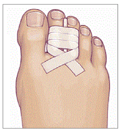 Drawing of foot with the broken toe will be strapped to the neighbouring toe.