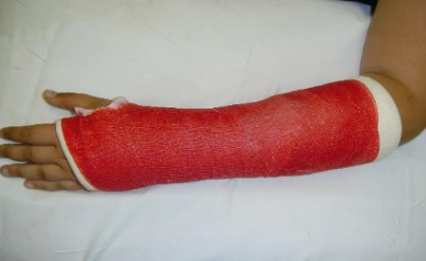 Example image of a soft cast.